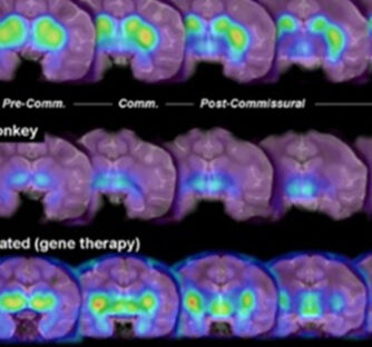Gene therapy efficacy in a non-human primate of Parkinson’s disease using PET imaging