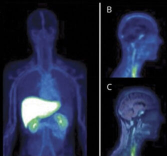 Pharmacology imaging in patient / Phase 0 Microdosing using PET/MRI
